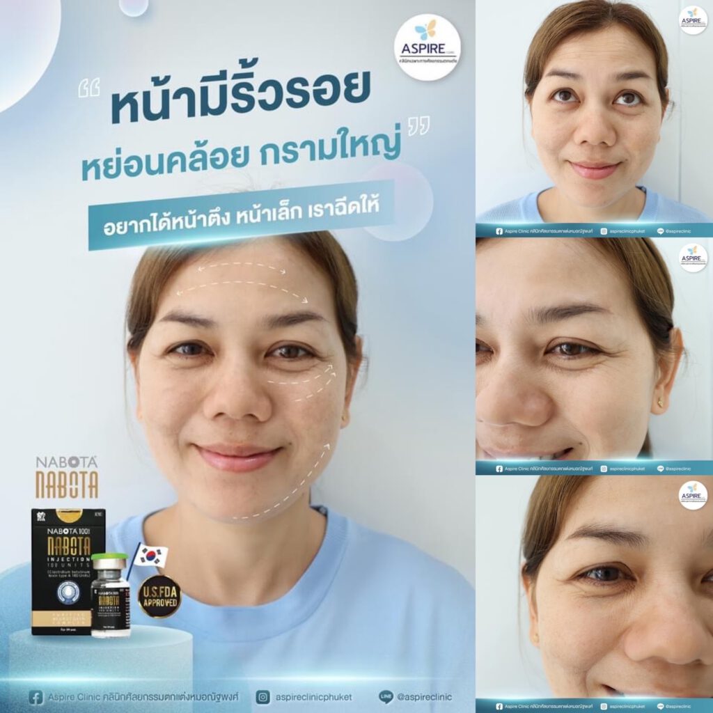 การฉีด botox