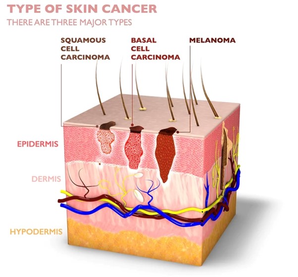 มะเร็งผิวหนัง